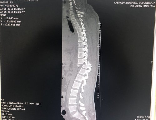 Thoraco-Lumbar Spine Trauma|Dr.Kiran Kumar Lingutla|Ameerpet,Hyderabad
