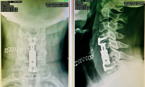 Complex Cervical Spine Surgery - Dr Kiran Lingutla|Dr. Kiran Lingutla|Ameerpet,Hyderabad