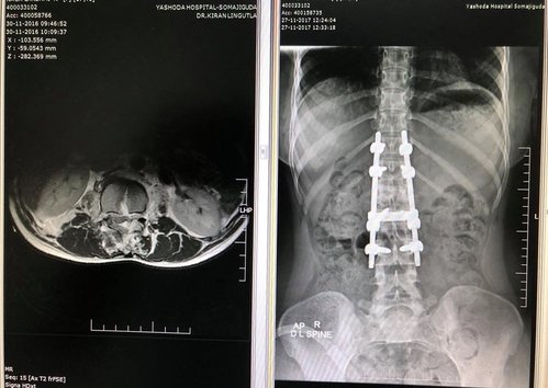 Spine column and Spinal cord Injury patient|Dr.Kiran Kumar Lingutla|Ameerpet,Hyderabad